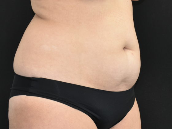 Abdominoplasty: Case 22 - Before