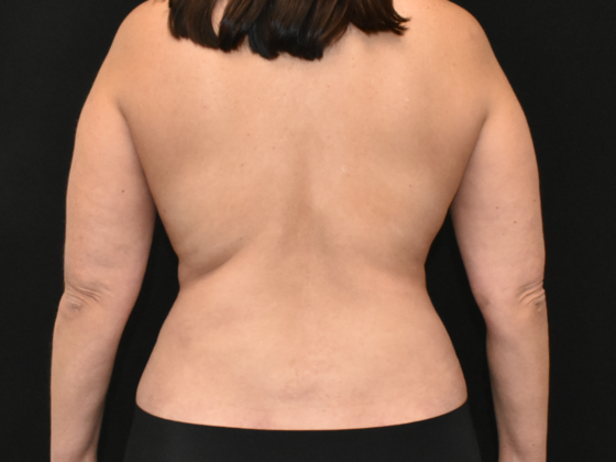 Abdominoplasty: Case 22 - After