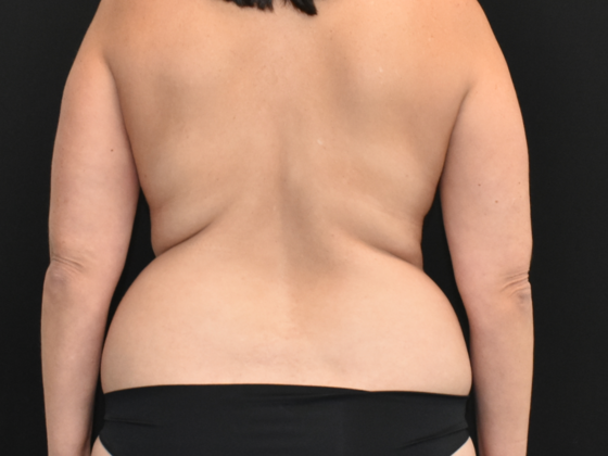 Abdominoplasty: Case 22 - Before