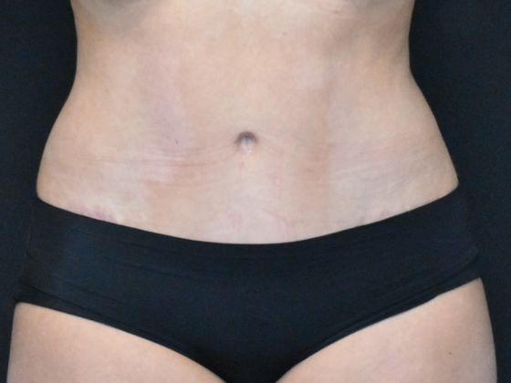 Abdominoplasty Case 22 - After
