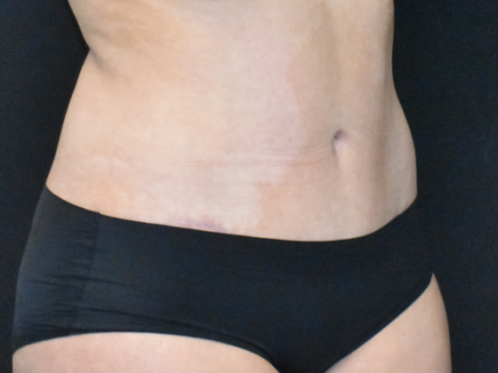 Abdominoplasty: Case 22 - After