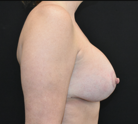 Mastopexy with Augmentation: Case 14 - After