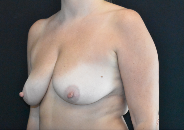 Mastopexy with Augmentation: Case 14 - Before
