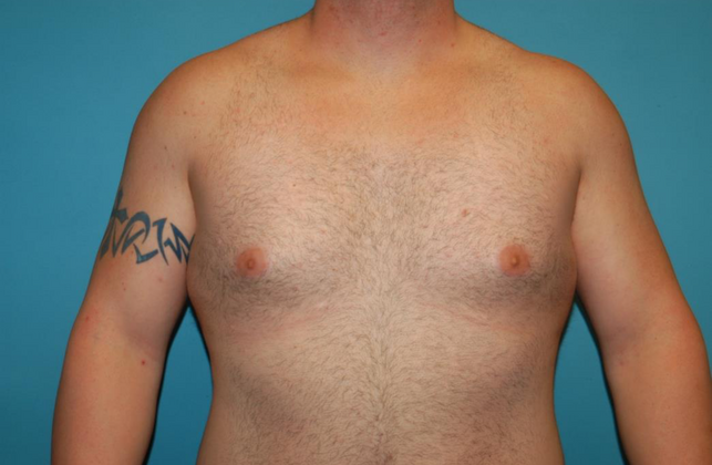 Gynecomastia Case 1 - After
