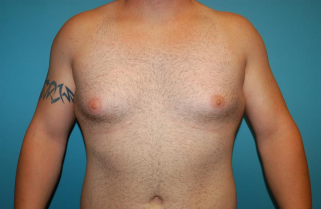 Gynecomastia Case 1 - Before