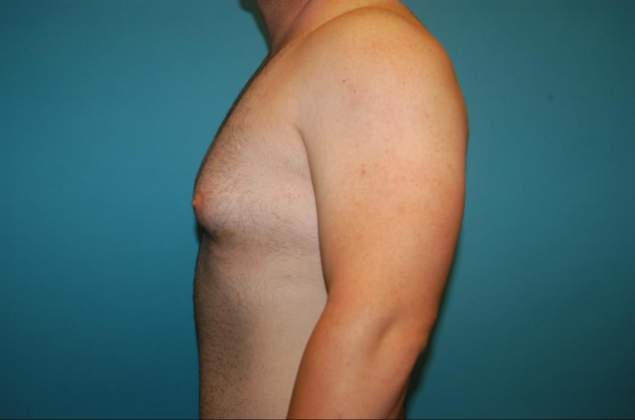 Gynecomastia: Case 1 - Before - Side 1