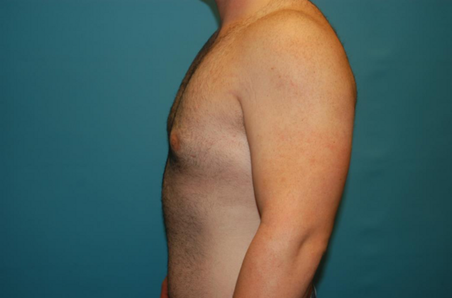 Gynecomastia: Case 1 - After - Side 1