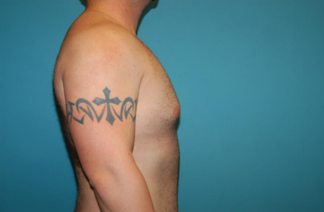Gynecomastia: Case 1 - After - Side 2