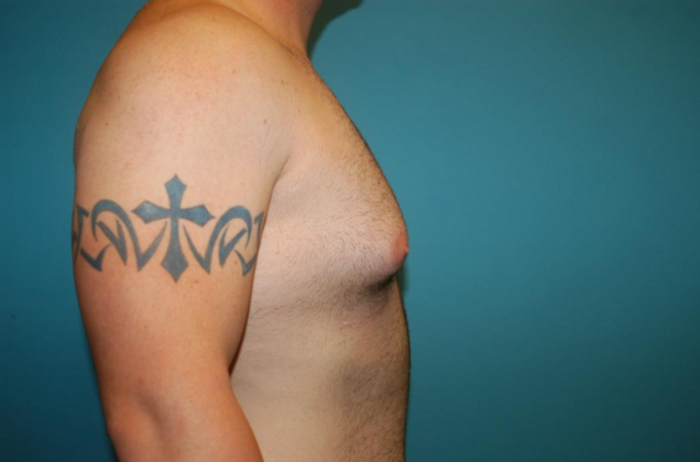 Gynecomastia: Case 1 - Before - Side 2