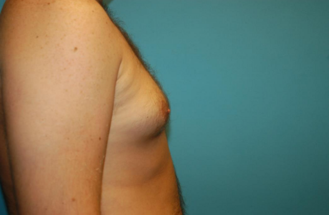 Gynecomastia: Case 2 - Before