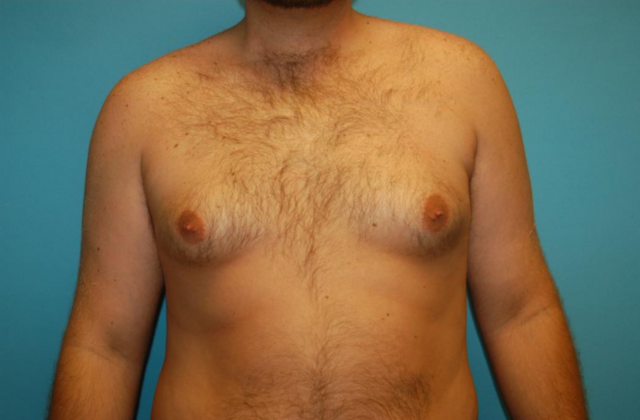 Gynecomastia Case 2 - Before
