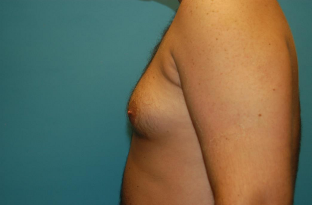 Gynecomastia: Case 2 - Before