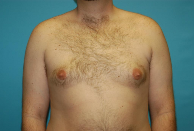 Gynecomastia Case 2 - After