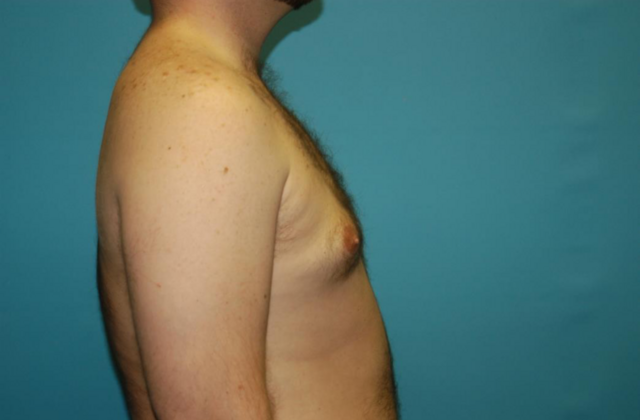 Gynecomastia: Case 2 - After