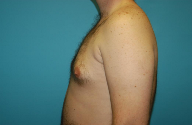 Gynecomastia: Case 2 - After