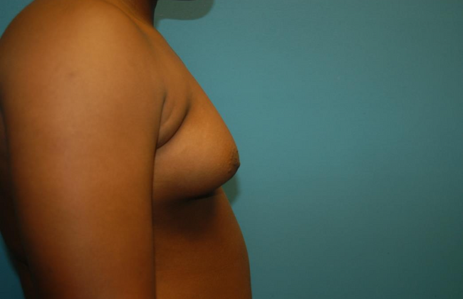 Gynecomastia: Case 3 - Before