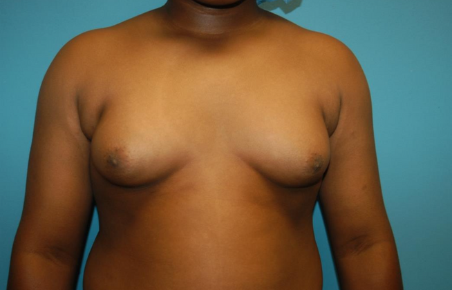 Gynecomastia Case 3 - Before