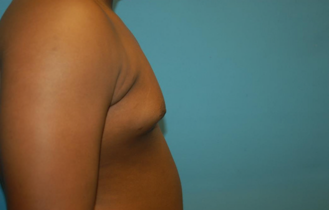 Gynecomastia: Case 3 - After