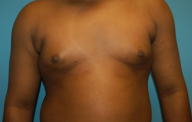 Gynecomastia Case 3 - After