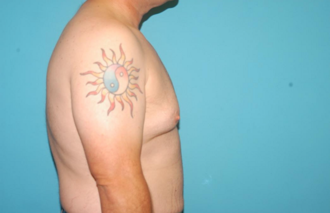Gynecomastia: Case 4 - Before