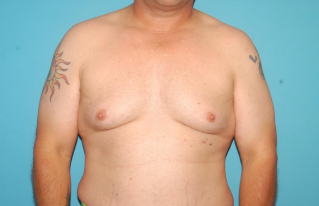 Gynecomastia Case 4 - Before