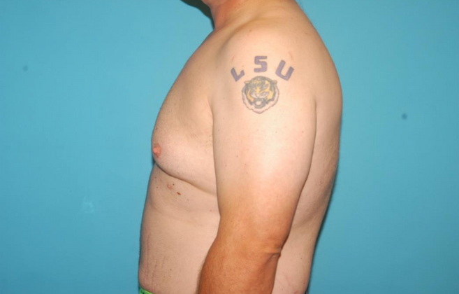 Gynecomastia: Case 4 - Before