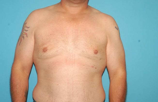 Gynecomastia Case 4 - After