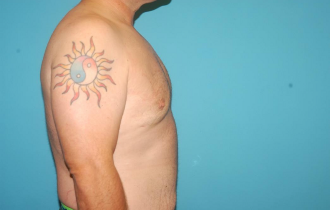 Gynecomastia: Case 4 - After