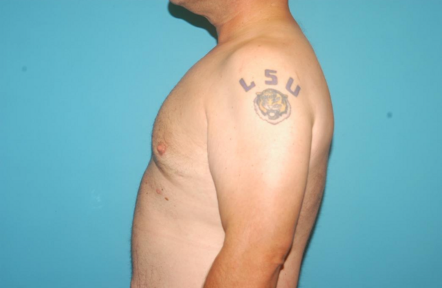 Gynecomastia: Case 4 - After