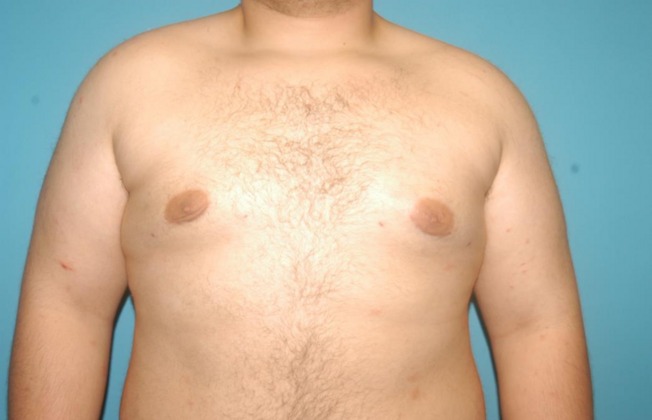 Gynecomastia Case 5 - After