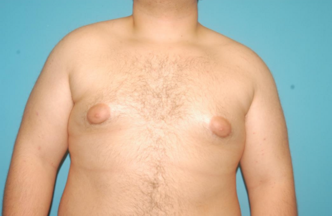 Gynecomastia Case 5 - Before