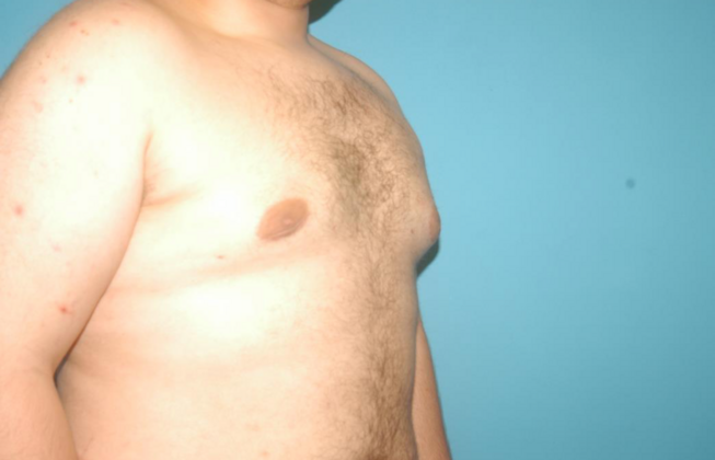 Gynecomastia: Case 5 - After