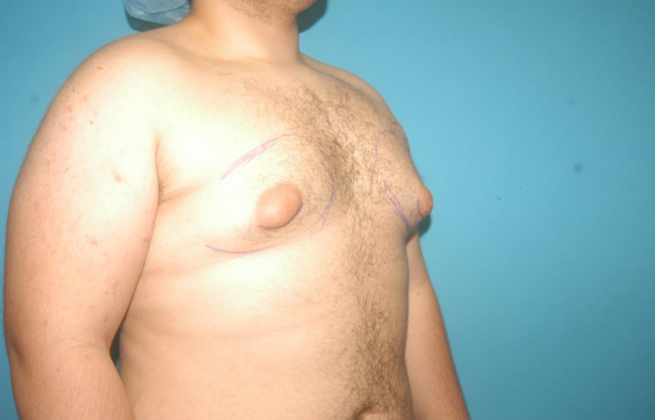 Gynecomastia: Case 5 - Before