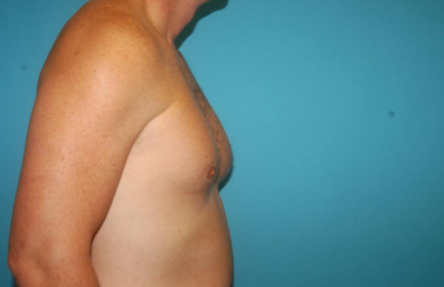 Gynecomastia: Case 6 - Before