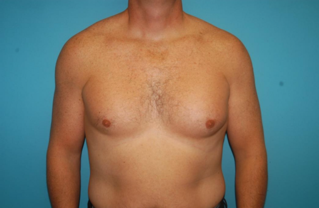 Gynecomastia Case 6 - Before