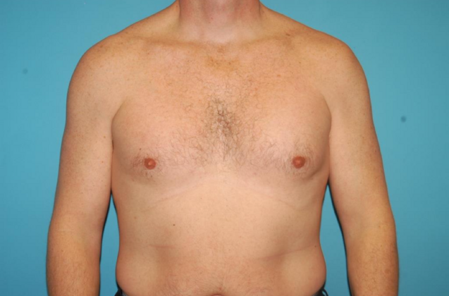 Gynecomastia Case 6 - After