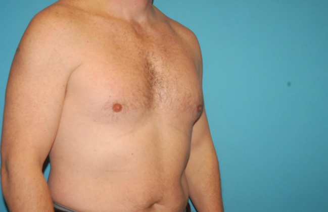 Gynecomastia: Case 6 - After