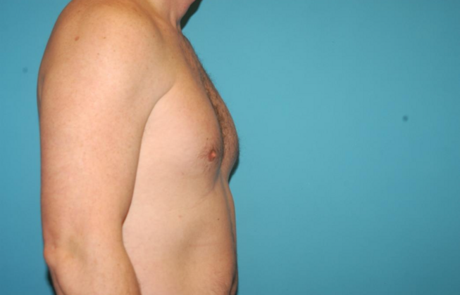 Gynecomastia: Case 6 - After