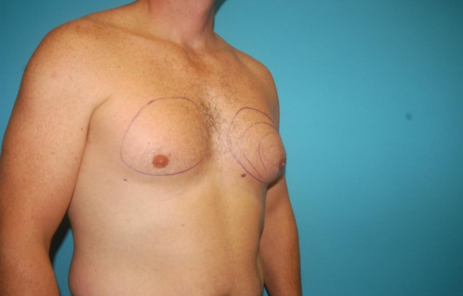 Gynecomastia: Case 6 - Before