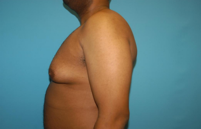 Gynecomastia: Case 7 - Before