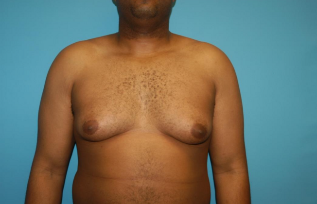 Gynecomastia Case 7 - Before