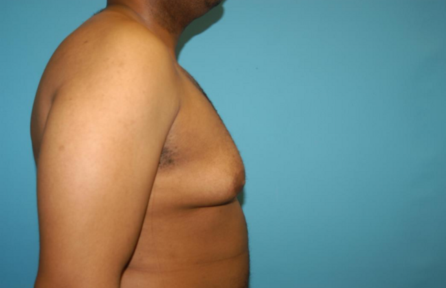 Gynecomastia: Case 7 - Before