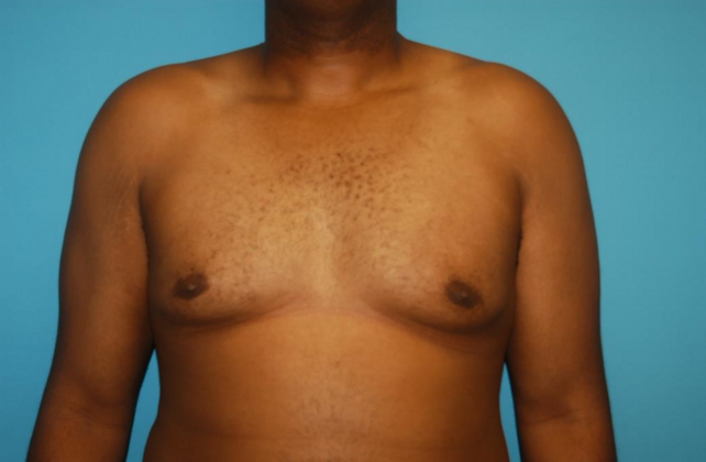 Gynecomastia Case 7 - After
