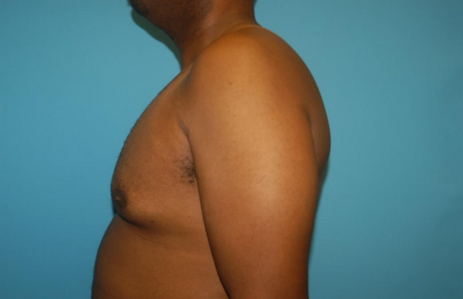 Gynecomastia: Case 7 - After