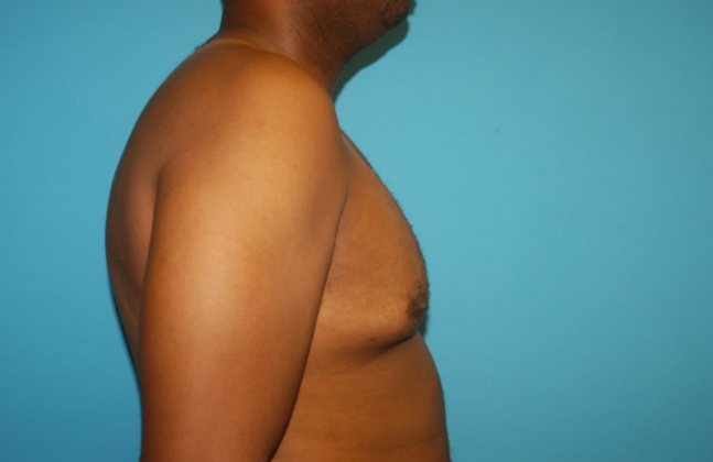 Gynecomastia: Case 7 - After