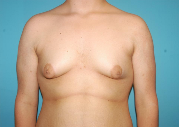 Gynecomastia Case 8 - Before