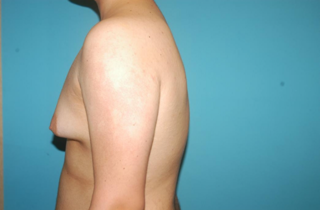 Gynecomastia: Case 8 - Before