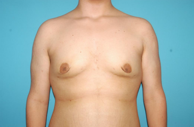 Gynecomastia Case 8 - After