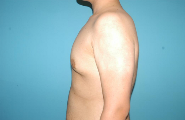 Gynecomastia: Case 8 - After
