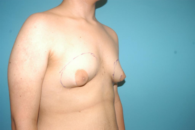 Gynecomastia: Case 8 - Before
